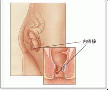 内痔百科