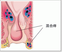 混合痔百科