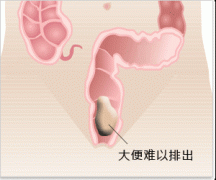 大便困难百科
