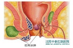 春柳中医肛肠医院帮您将肛周脓肿治疗进行到底