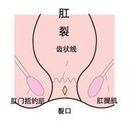 肛裂