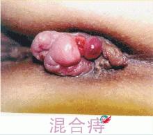 痔疮百科
